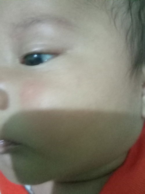 Pipi bayi merah merah