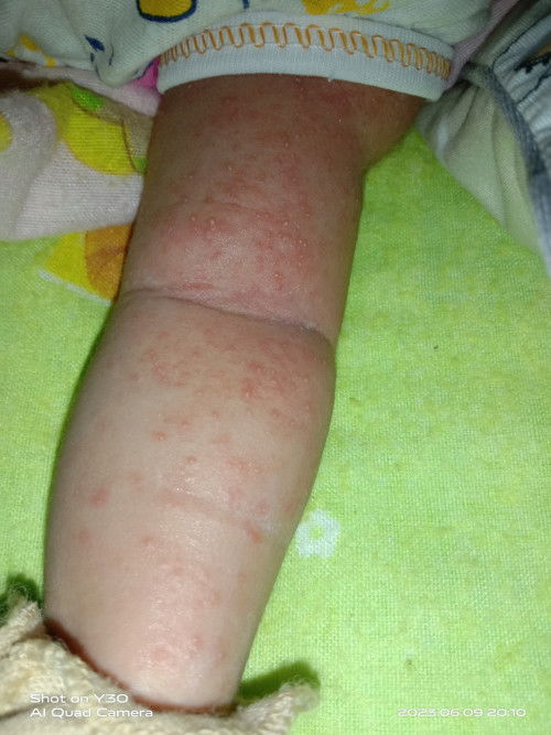 Bruntusan bayi newborn