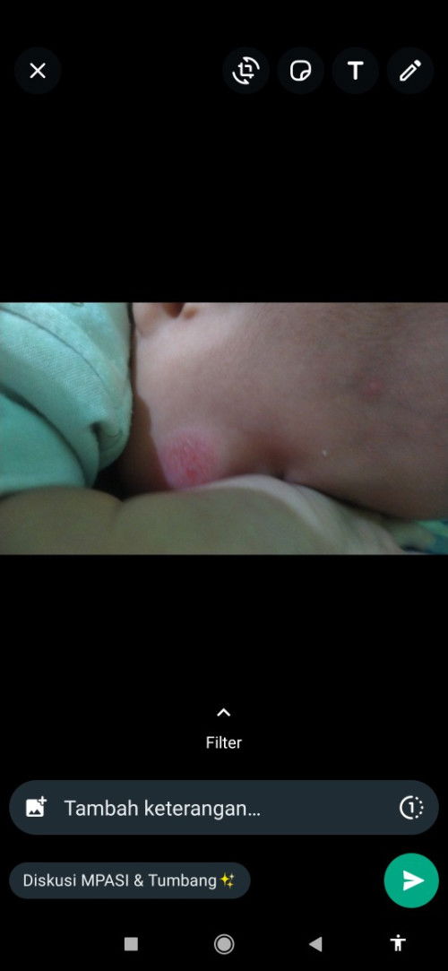 Maaf bunda² mau nnyak ini kenapa ya dri usia 2 BLN smpai jalan 4 bulan ga ilang²