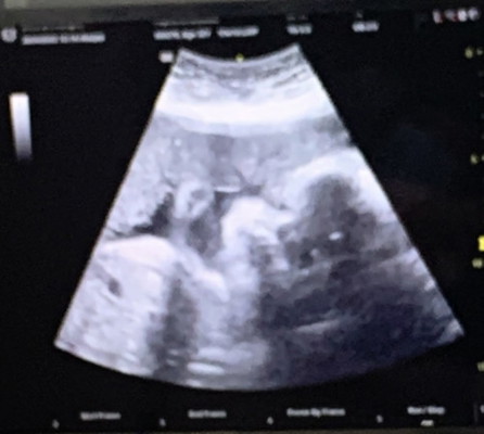 37w3d แล้วท้อง2แล้วยังตื่นเต้นเลย👶🏻