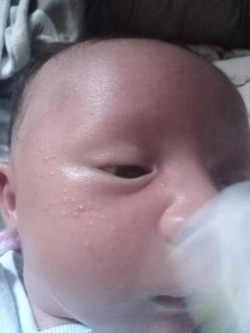 Bintik2 merah pada pipi