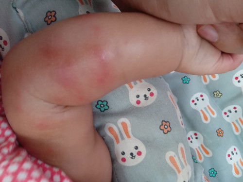 มดกัดจนบวม