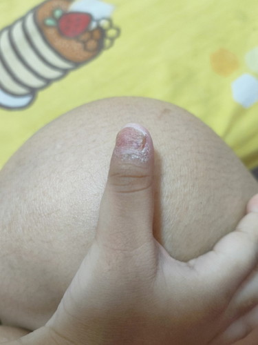 เล็บเเบบนี้อยากทราบว่าใช่เชื้อราไหมค่ะ
