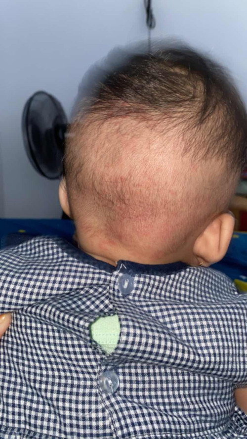 Bruntusan di kepala bayi