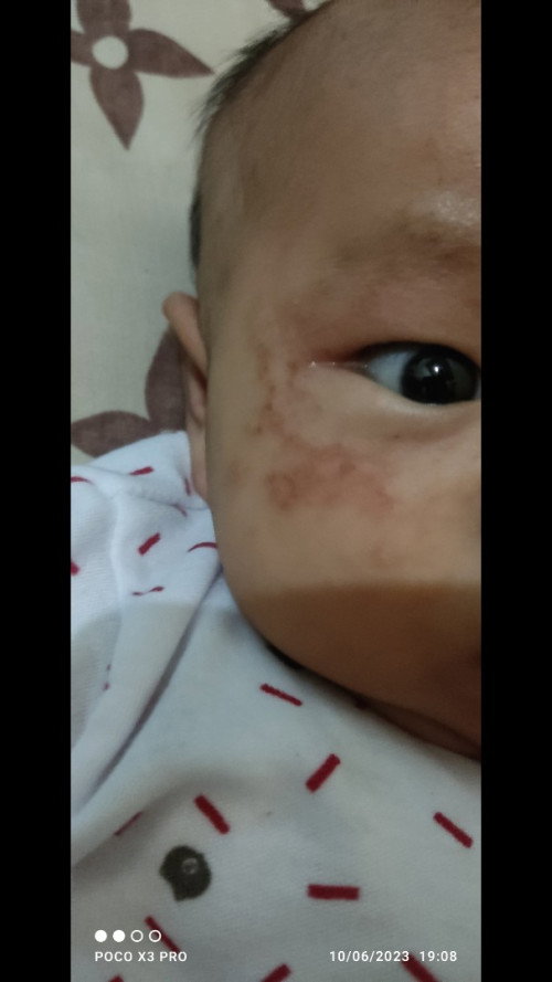 kulit kering merah