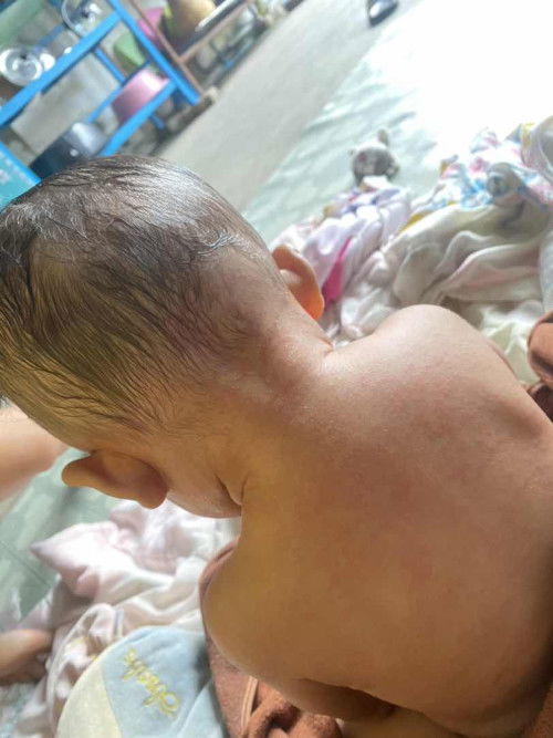 ผื่นเเดง/ออกเเดง