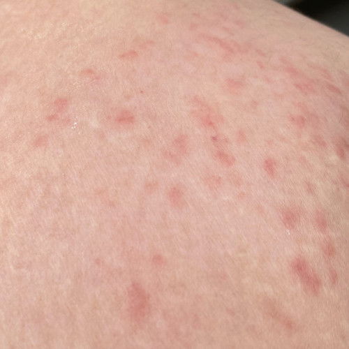 33w naik ruam dan bintik merah. Gatal gatal seluruh badan