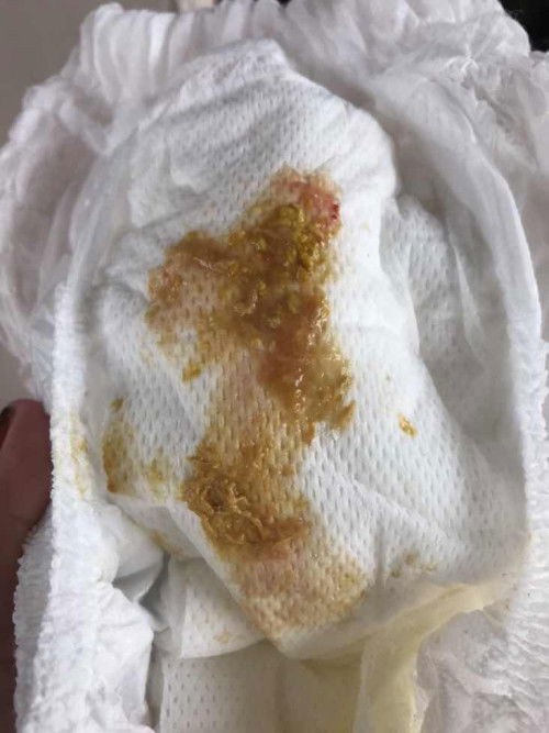 ถ่ายออกมูกเลือด