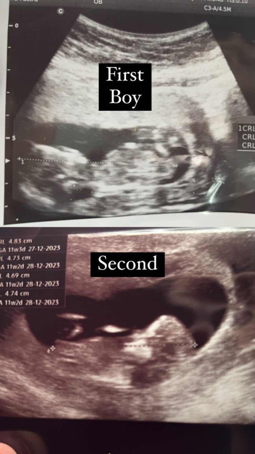 Perbezaan kedudukan Bayi