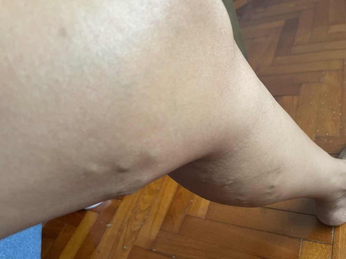 Developing Varicose Vein