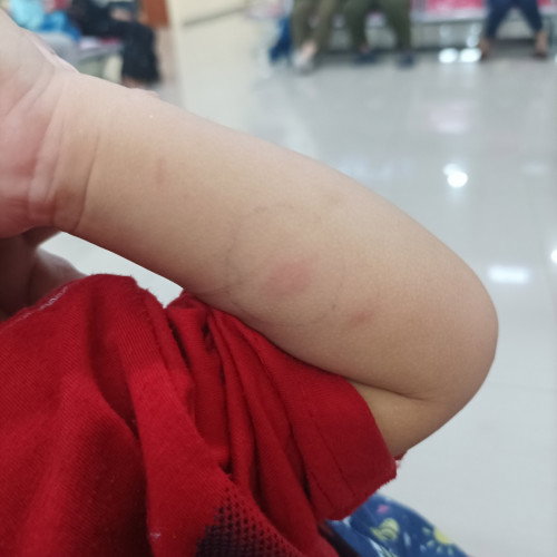 Anak positif TBC