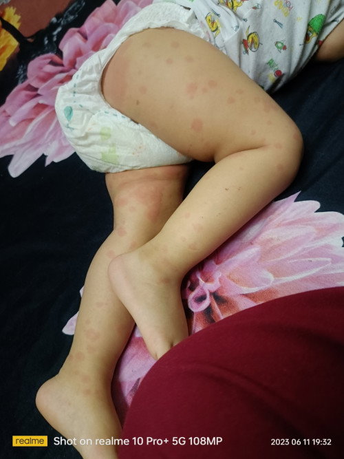Ano po kaya ito ka mom's , kahapon kumakati sya kaya pinainom ko cetirizine Tas ngaun mas dumami
