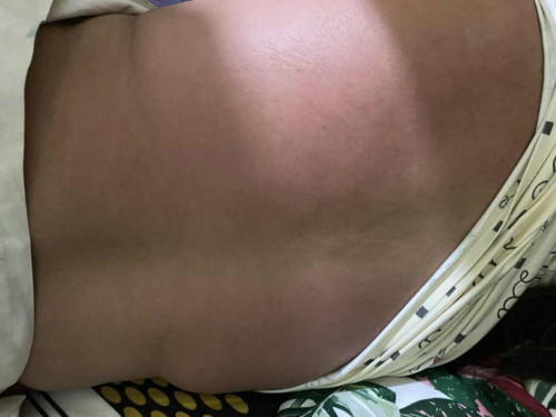 Please help me po, two days natong pantal pantal a sobrang at init at makati.
Pregnant po 11 week