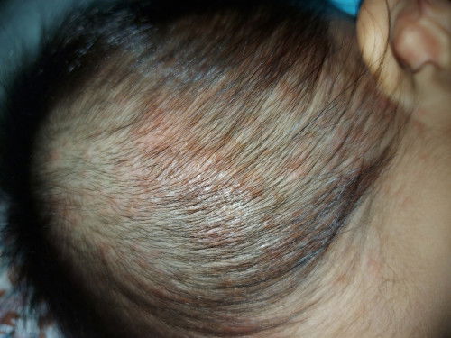 Kepala bayi gatal dan bintik merah