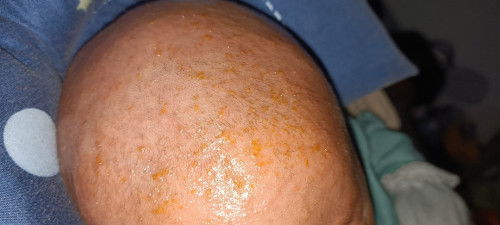 Assalamualaikum bun, ada kah yang kepala atau kulit baby nya kaya gini?