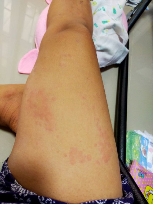 ผื่นหลังคลอด