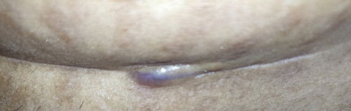 Setelah Oprasi sesar 1 bulan lebih, seperti benjol lunak, apakah keloid atau bukan?