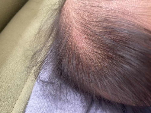 หนังหัวลอกแบบนี้ แนะนำหน่อยคะเป็นอันตรายมั๊ยคะ