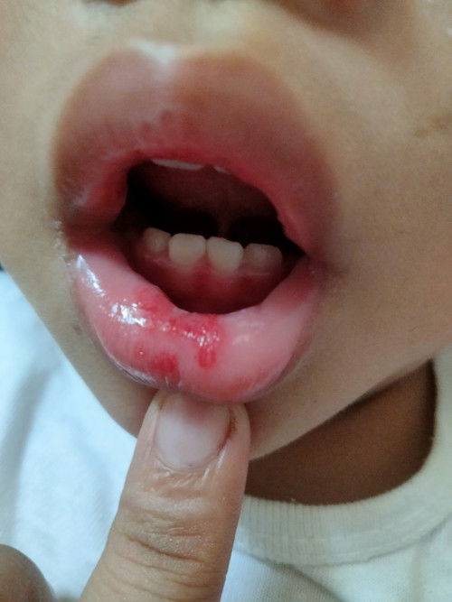 Mga mie ano po kaya ito sa lips ni baby delekado po ba ito?