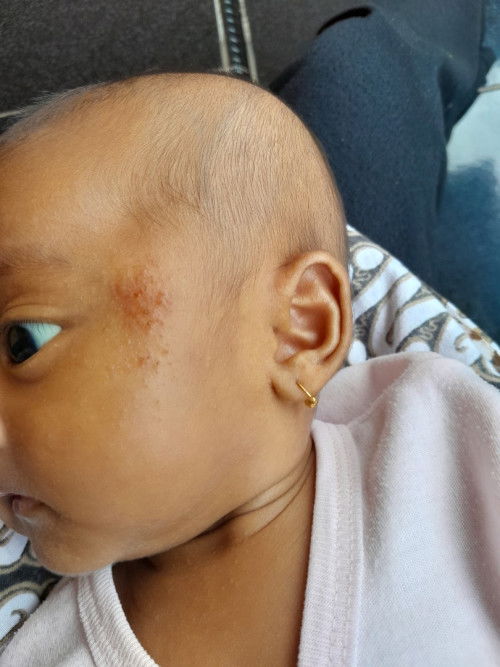 Bintik merah di muka dan cara mengatasinya..