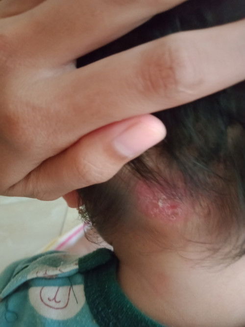 Merah dan Gatal dibelakang kepala