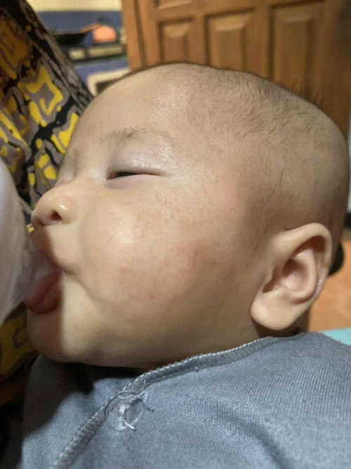 Ruam pipi bayi 2 bulan 7 hari