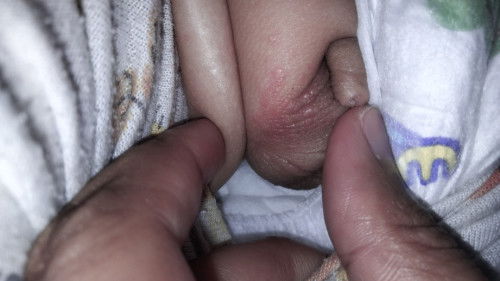 Bintik bintik merah di kemaluan bayi