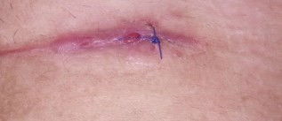 Luka pasca SC tidak kunjung sembuh pdhl sudah 2 bulan