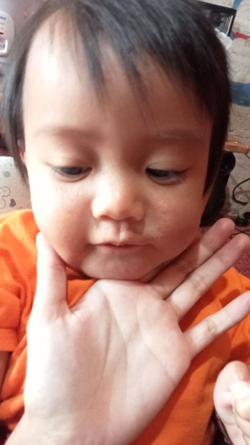 Anakku umr 9bln kena alergi baby cream udh berobat bbrpa kali di kasi salep mlh smakin merah pipinya