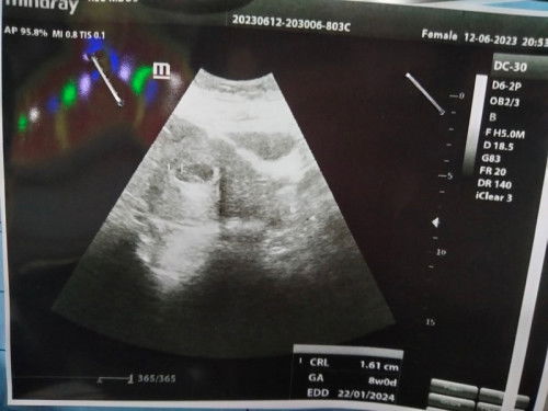 Belom terdengar djj janin usia 8week