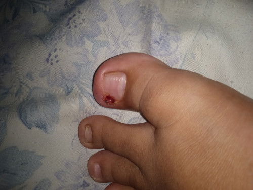 Cantengan di jempol kaki