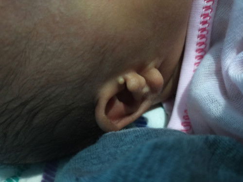 Ada benjolan di telinga baby,bun ada yang tau ndak ini benjolan apa 🥺