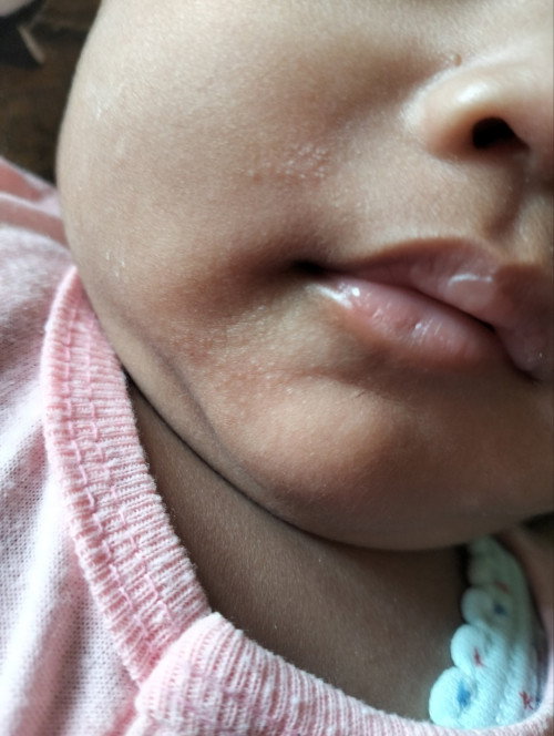 Kulit bayi ada seperti gatal alergi