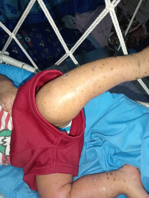 scar removal product