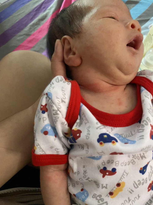 ผื่นแบบนี้เกิดจาก ะไรรักษายังไงดีค่ะ