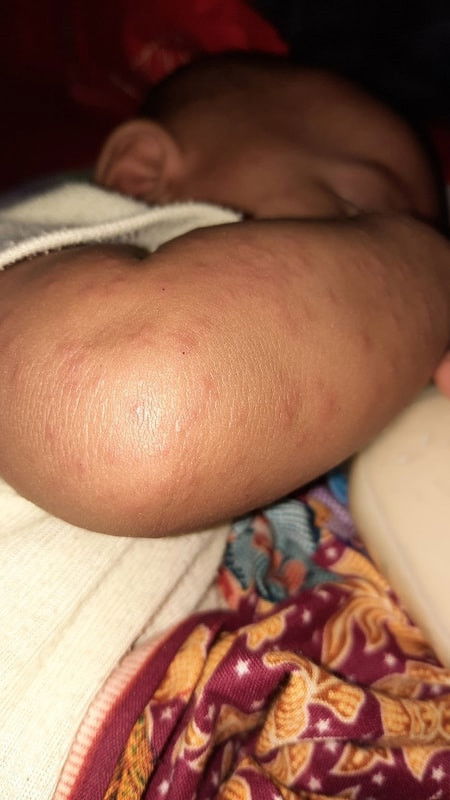 Anak gabakan/campak diseluruh tubuh.