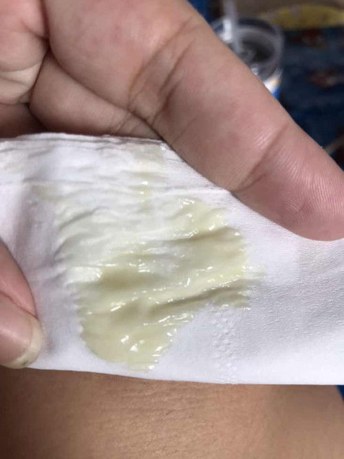 ของเหลวไหลออกมาจากช่องคลอด สีเขียวปนเหลือง (เบลอภาพแล้วน่ะค่ะ ภาพดูไม่ค่อยดี ใครรับได้กดดูได้น่ะค่ะ ขอบคุณค่ะ🙏🏻🙏🏻)