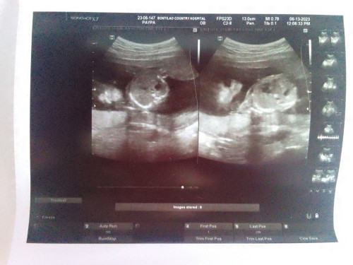 Transabdominal Ultrasound