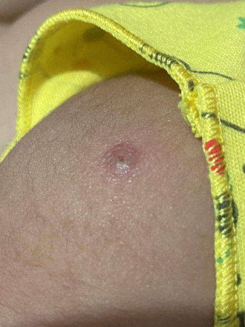 Bekas suntik imunisasi