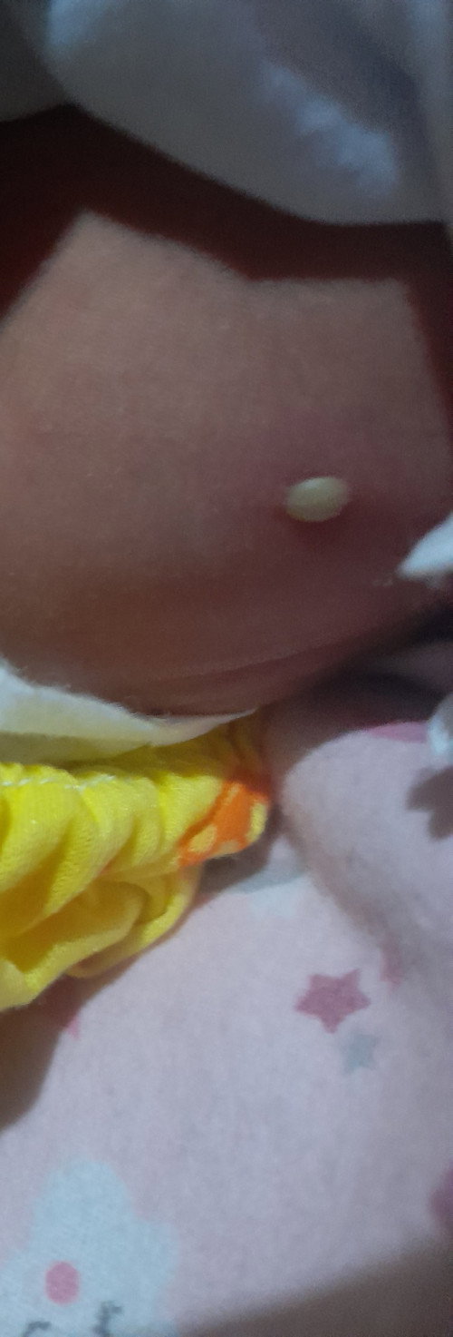 Normal lang po ba ito sa newborn? 
7 days nya lang po nagkaroon sya ng nana sa tiyan