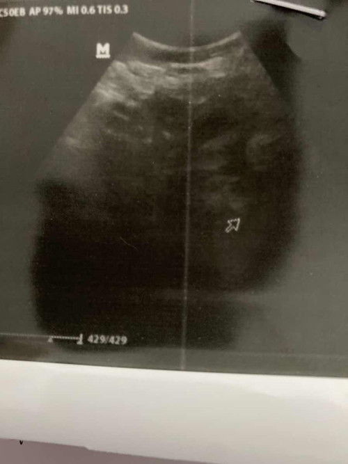 7 week masih penebalan rahim