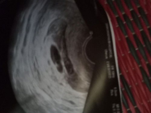 อัลตร้าซาวด์แต่ไม่เจอตัวอ่อน