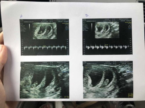 ขอคำแนะนำสำหรับคุณแม่ท้องแฝดหน่อยค่ะ