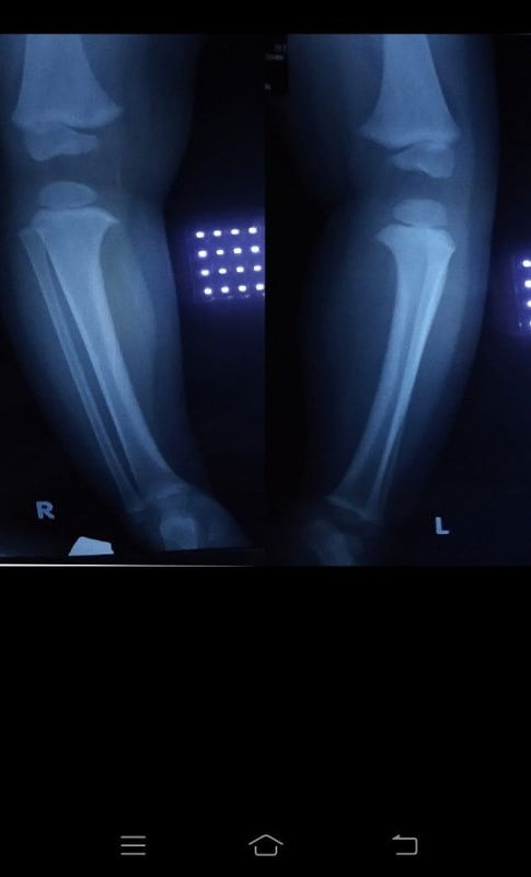 BLOUNT DISEASE & KAFO BRACE bikin stressss 😭