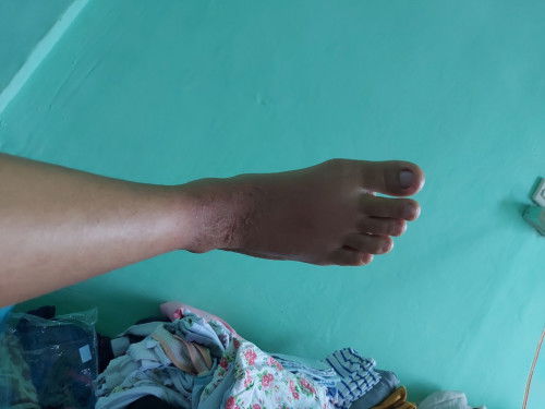 Penggunaan betametason saat hamil