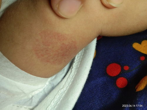 Namumula na bilog sa may hita