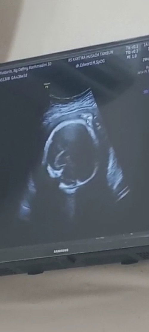 Tangan janin diatas kepala