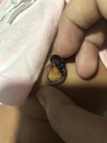 สะดือลูกเปียกแฉะ