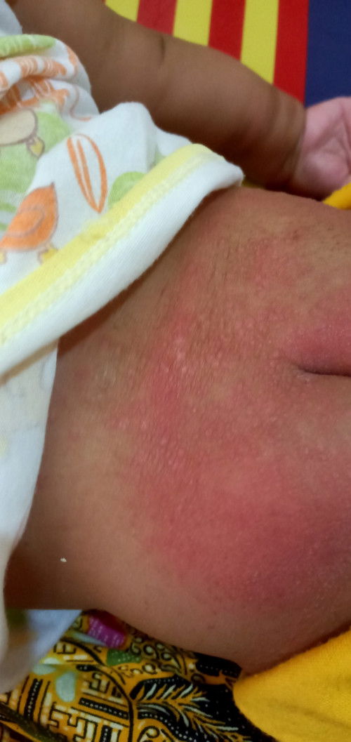 Ruam gak tau gegara beda suhu udara, gak tau gegara beli pempers di tiktok