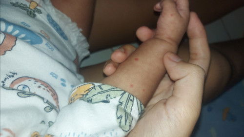 ตุ่มแดงขึ้นที่แขน